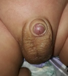Sünnetten sonra küçülmüş gibi gözüken penis